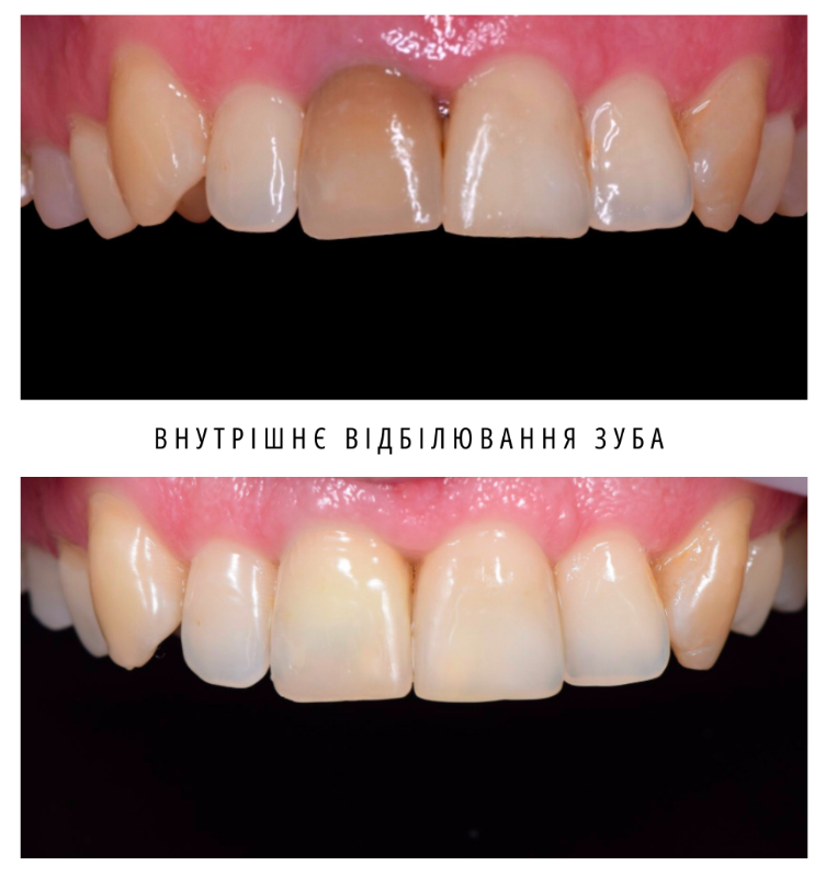 Внутрішнє відбілювання зуба (Ендовідбілювання, внутрішньокоронкове відбілювання)