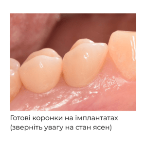 коронка на імпланті